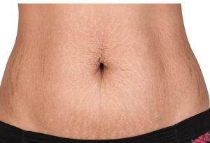 Best Home Treatment for Stretch Marks 