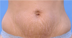 Best Home Treatment for Stretch Marks 